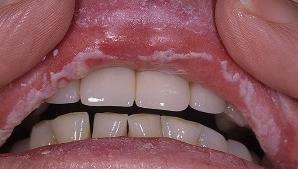 Кандидозный стоматит лечение