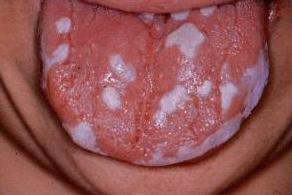 Кандидозный стоматит симптомы