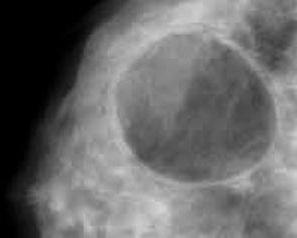 Киста молочной железы фото