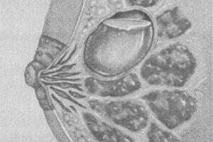 Киста молочной железы лечение