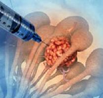 Киста молочной железы