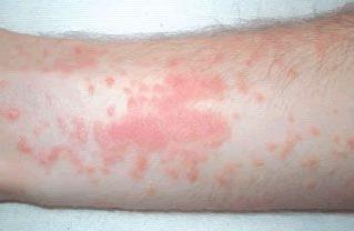 Контактный дерматит фото