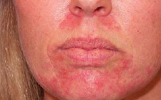 Контактный дерматит лечение