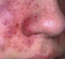 Контактный дерматит