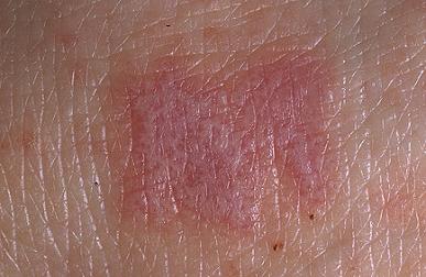Красный плоский лишай