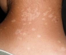 Лишай у человека