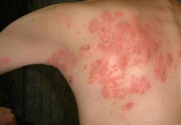 Опоясывающий лишай