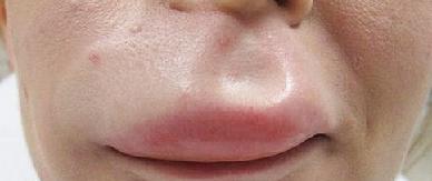 Отек Квинке фото