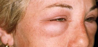 Отек Квинке лечение