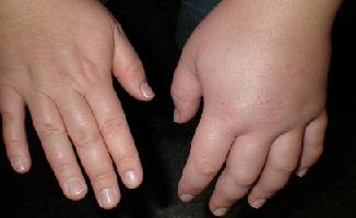 Отек Квинке причины