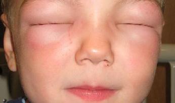 Отек Квинке симптомы