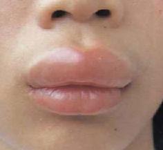 Отек Квинке