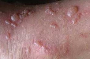 Ожог кипятком лечение