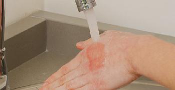 Ожог кипятком первая помощь