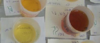 Причины темной мочи