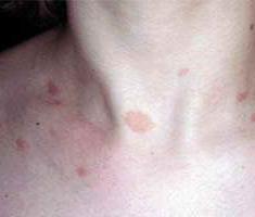 Пятна на теле похожие на лишай