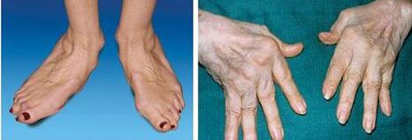 Ревматоидный артрит фото