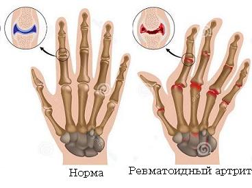Ревматоидный артрит причины
