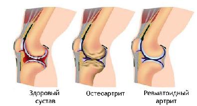 Ревматоидный артрит признаки