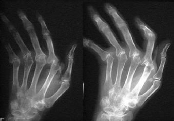 Ревматоидный артрит рентген