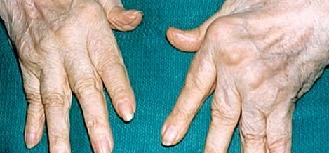 Ревматоидный артрит симптомы