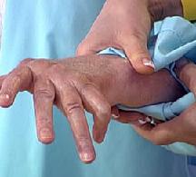 Ревматоидный артрит