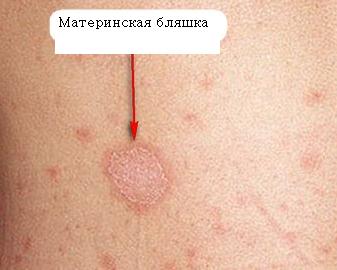 Розовый лишай