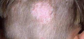 Стригущий лишай