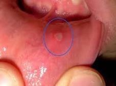 Травматическая язва