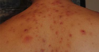 Угри на спине фото