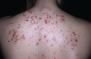 Угри на спине лечение