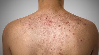 прыщ на спине