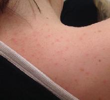 Угри на спине