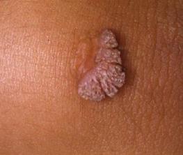 Вирус папилломы человека