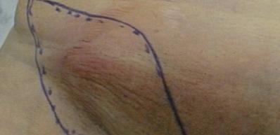 Воспаление лимфоузлов в паху фото