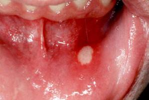 Язвы во рту фото
