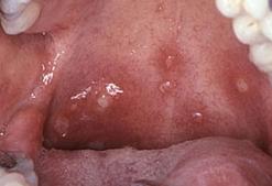 герпетиформный стоматита