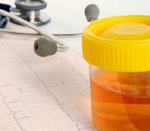 моча темного цвета