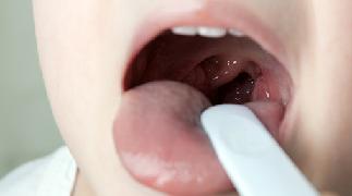 стафилококк в горле симптомы