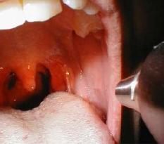 стафилококк в горле