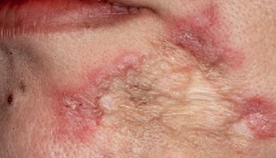 туберкулез кожи