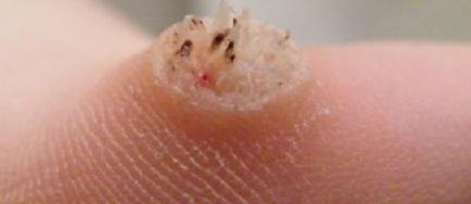 впч бородавки