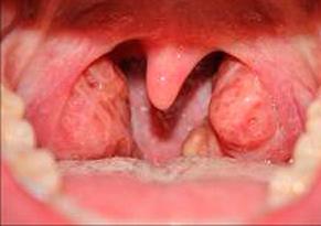 золотистый стафилококк в горле