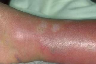 Болезнь рожа на ноге