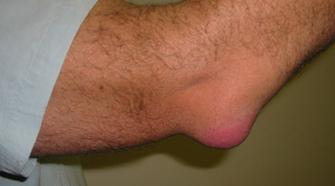 Бурсит локтя