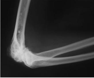 Деформирующий остеоартроз