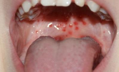 Герпетическая ангина фото