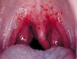 Герпетическая ангина симптомы