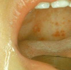 Герпетическая ангина у детей