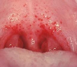 Герпетическая ангина